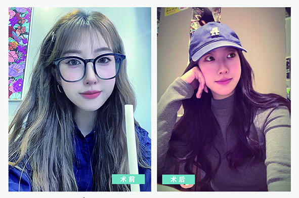 营口何氏眼科医院员工摘镜日记    第五期